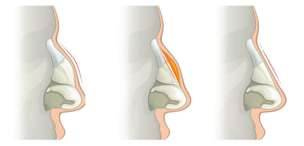 image de la structure osseuse d'un nez