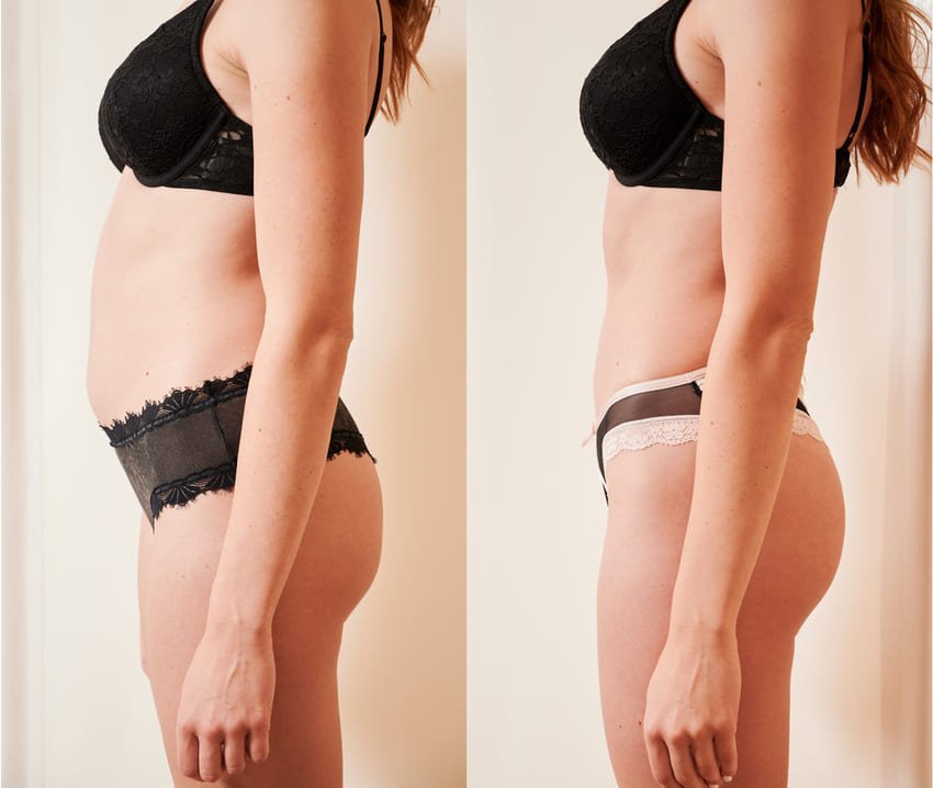 Photo avant et après d'une abdominoplastie d'une femme