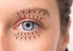 blepharoplastie