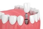 implant dentaire